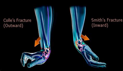 Smith Fracture Review .